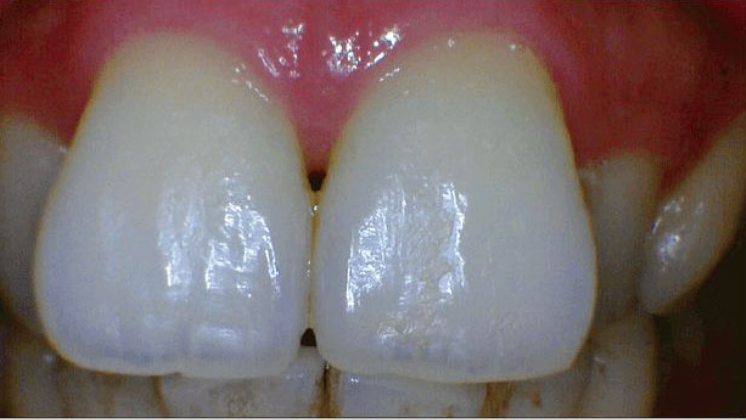 FHD Intraoralkamera HDI-220D