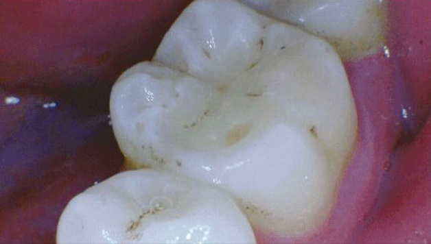 FHD Intraoralkamera HDI-220D